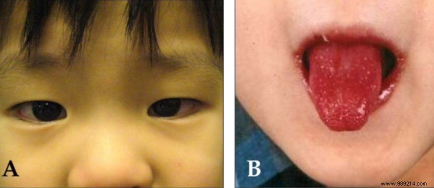 UK NHS Issues Alert on Rare Inflammatory Syndrome in Children Mimicking COVID-19