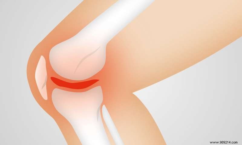 Breakthrough Research Ignites Hope for Curing Osteoarthritis: Cartilage Regeneration Advances