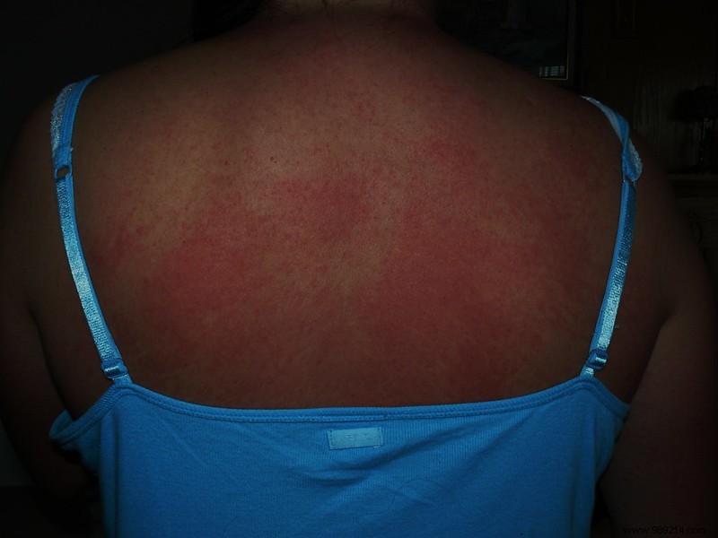 Man Suffers Near-Fatal Allergic Reaction to Cold After Hot Shower: A Case of Cold Urticaria
