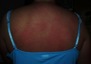 Man Suffers Near-Fatal Allergic Reaction to Cold After Hot Shower: A Case of Cold Urticaria
