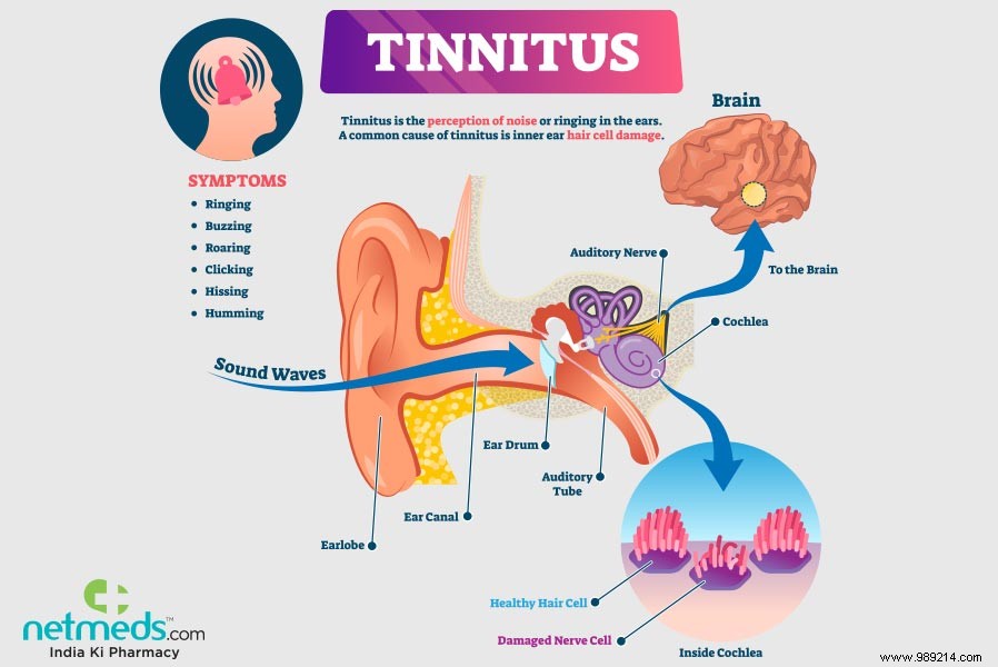 Promising Irish Device Offers New Hope for Tinnitus Relief, Study Reveals