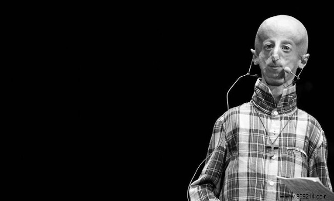 FDA Approves Zokinvy: First Drug for Progeria, Extending Life Expectancy by 2.5 Years