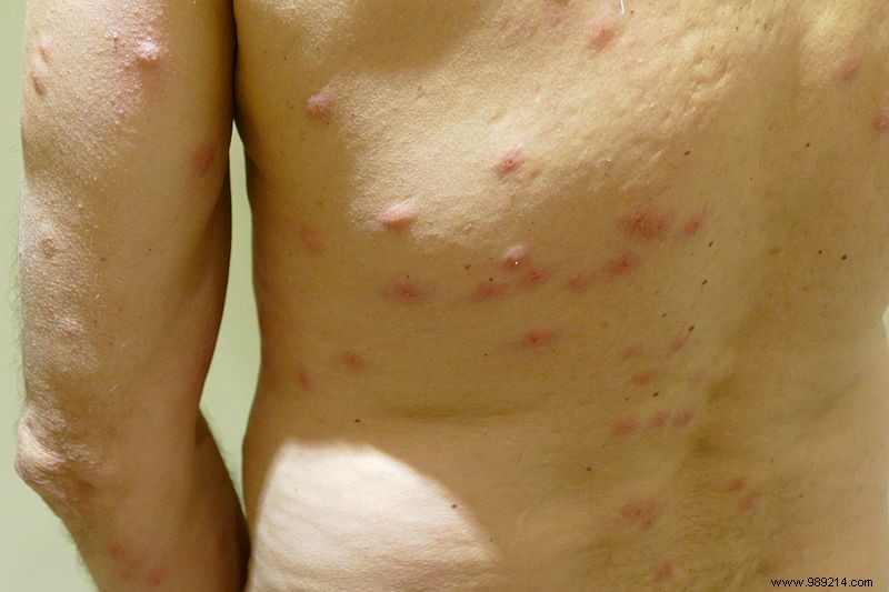 How to Eliminate Bed Bugs: Proven Detection, Treatment, and Prevention Strategies