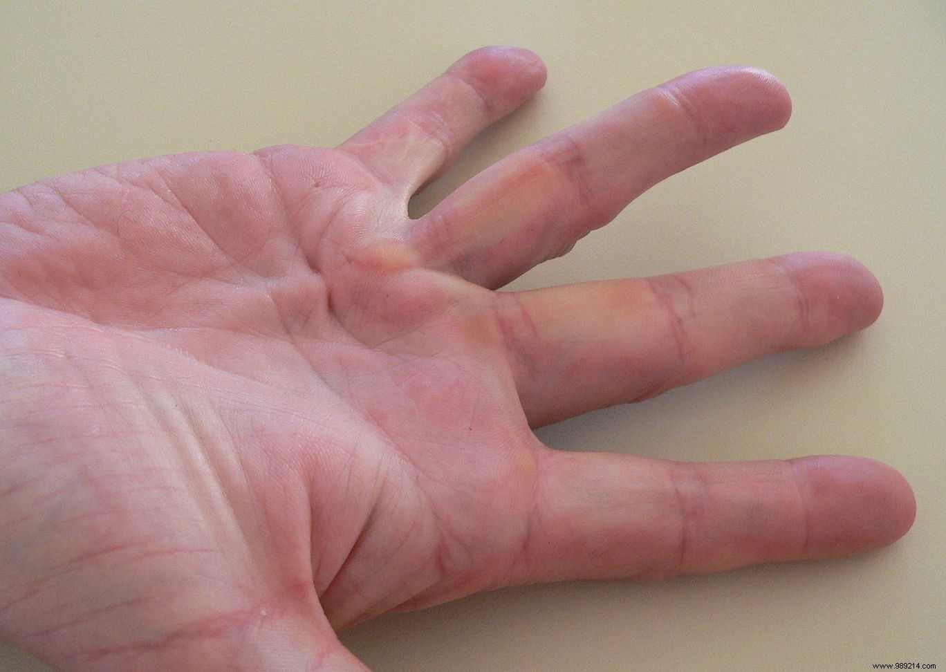 Dupuytren s Disease: The  Viking Disease  Predominantly Affecting Icelanders