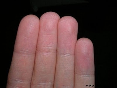 Bangladeshi Family Born Without Fingerprints: The Rare Genetic Disorder Adermatoglyphia