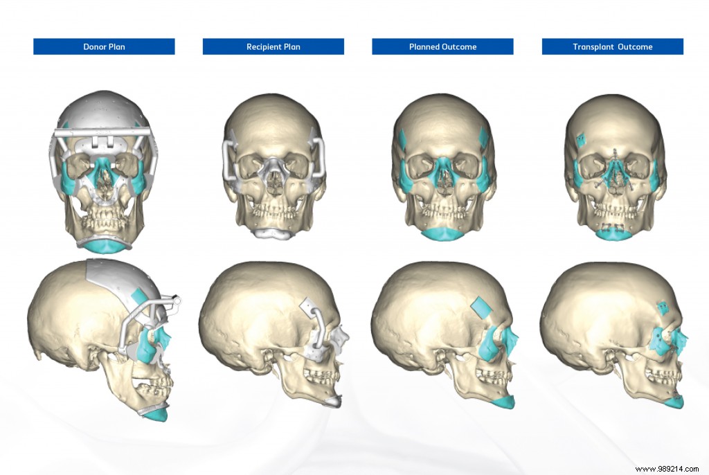 World s First Double Hand and Face Transplant: Revolutionized by 3D Printing