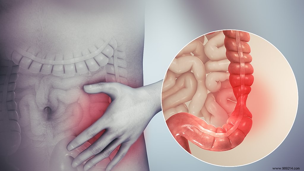 Researchers Uncover How Intestinal Infections Trigger Irritable Bowel Syndrome