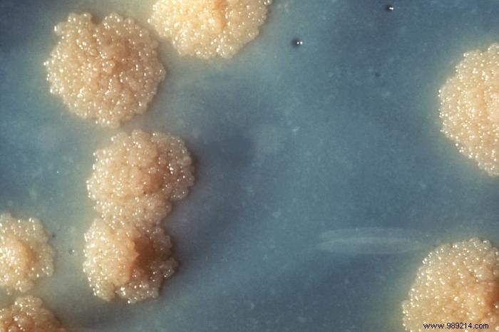 Rare Tuberculous Lupus: Woman s Ear Resembles  Cooked Apple Jelly  After Decades of Latent TB