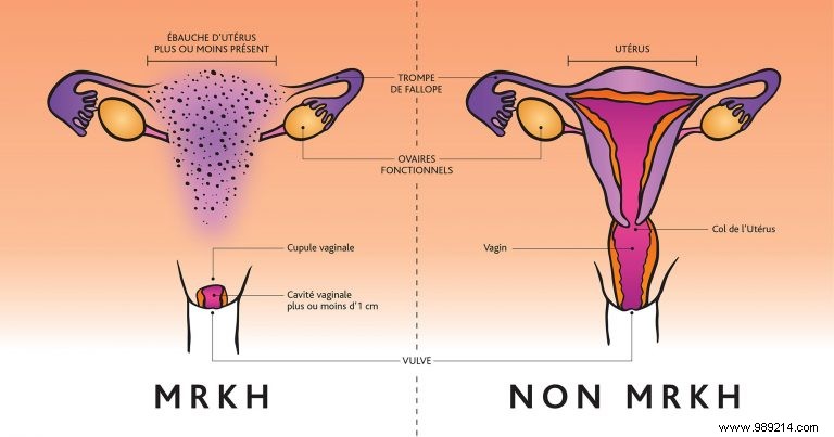 Mayer-Rokitansky-Küster-Hauser (MRKH) Syndrome: Women Born Without a Uterus or Vagina