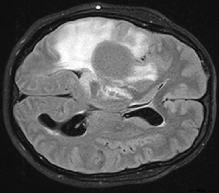 Promising Phase 1 Results: IDH1-Targeted Vaccine for Brain Tumors
