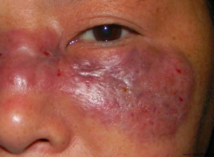 India s COVID-19 Crisis: Surge in Severe Black Fungus Mucormycosis Among Recovering Patients