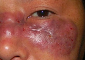 India s COVID-19 Crisis: Surge in Severe  Black Fungus  Mucormycosis Among Recovering Patients