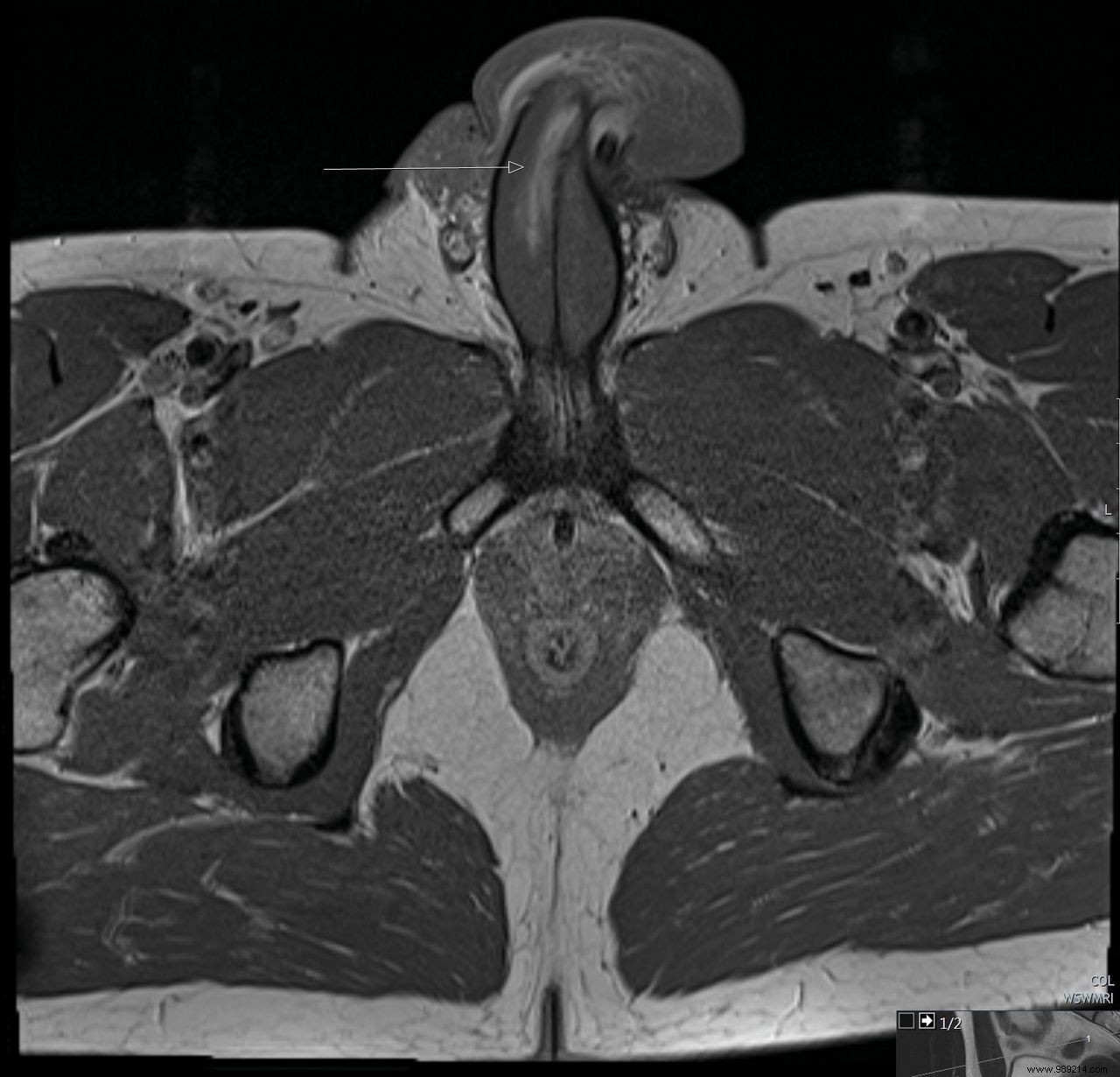 First Documented Case of Vertical Penile Fracture: Insights from British Urologists