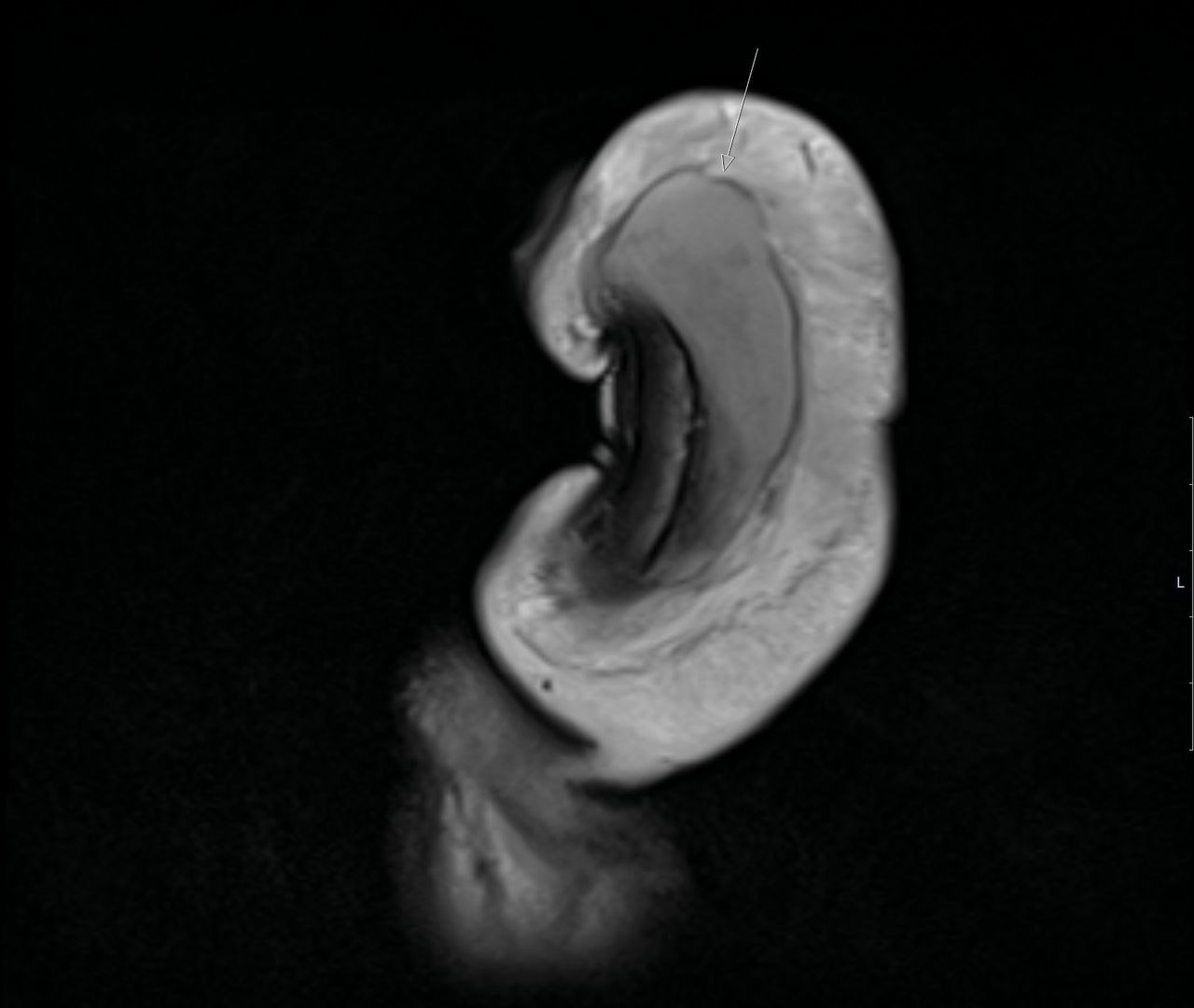 First Documented Case of Vertical Penile Fracture: Insights from British Urologists