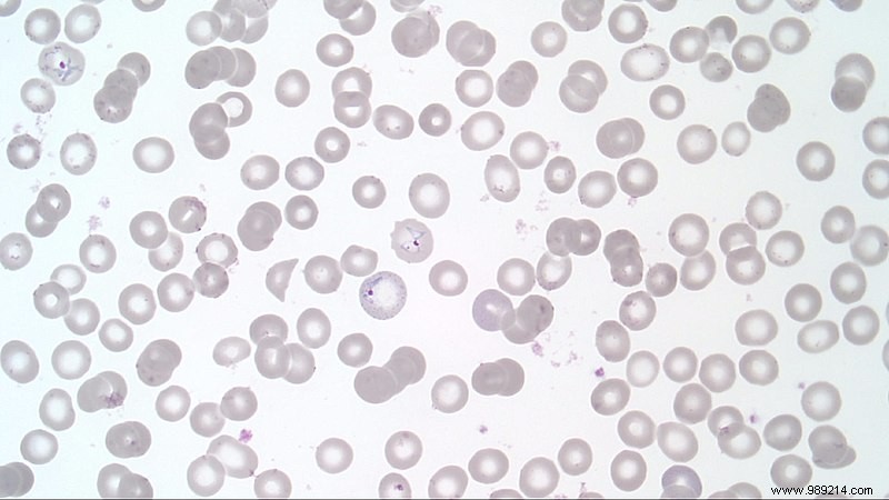 Mutant Malaria Parasite in Ethiopia Evades Standard Tests, Threatening Treatment Efforts