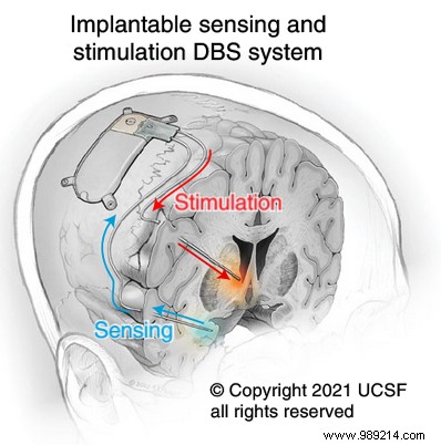 Breakthrough Brain Implant Relieves Severe Depression in UK Patient