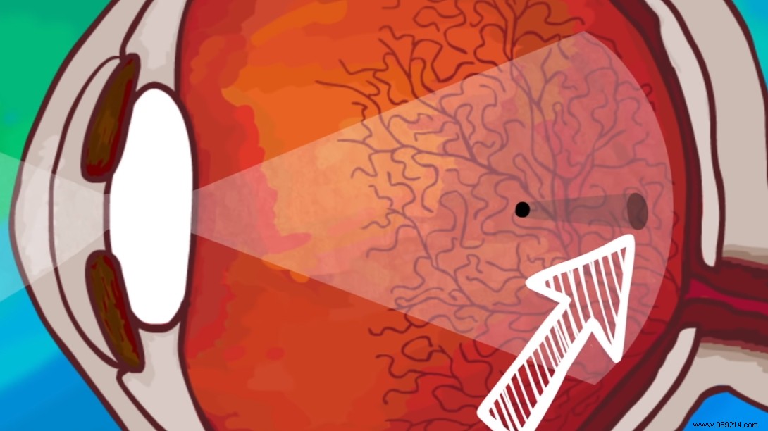 Eye Floaters Explained: What Causes Those Tiny Shapes in Your Vision?