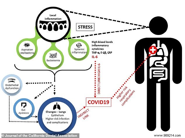 Poor Oral Health Linked to Higher Risk of Severe COVID-19: Evidence from Key Studies