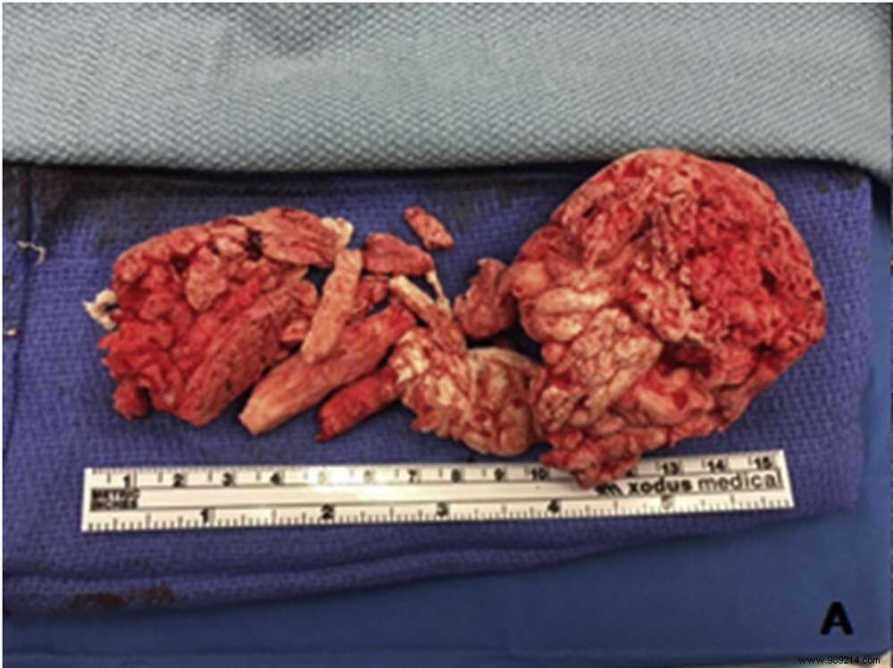 Urology Case Report: Insulating Foam Obstructs Urethra After DIY Erectile Dysfunction Attempt
