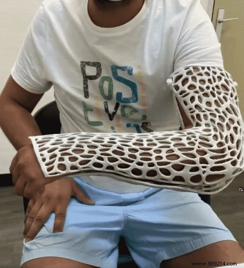 French Startup Skincasts Unveils Revolutionary 3D-Printed Splints at CES 2022