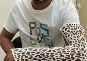 French Startup Skincasts Unveils Revolutionary 3D-Printed Splints at CES 2022