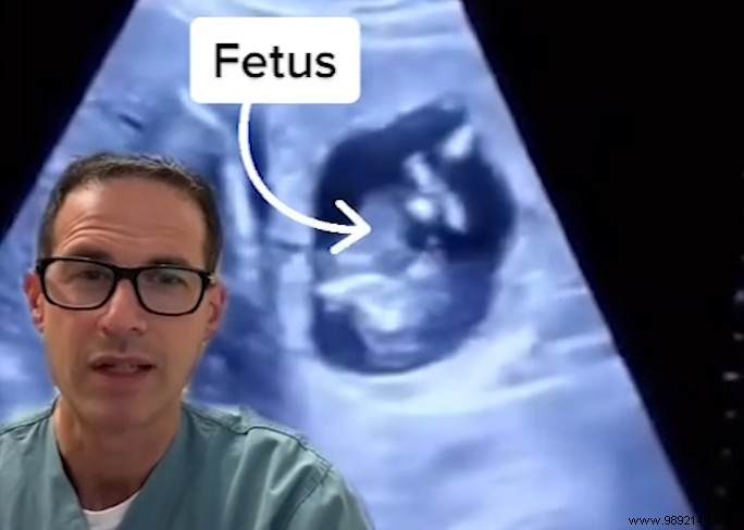 Ultra-Rare Hepatic Ectopic Pregnancy: Fertilized Egg Implants in Woman s Liver