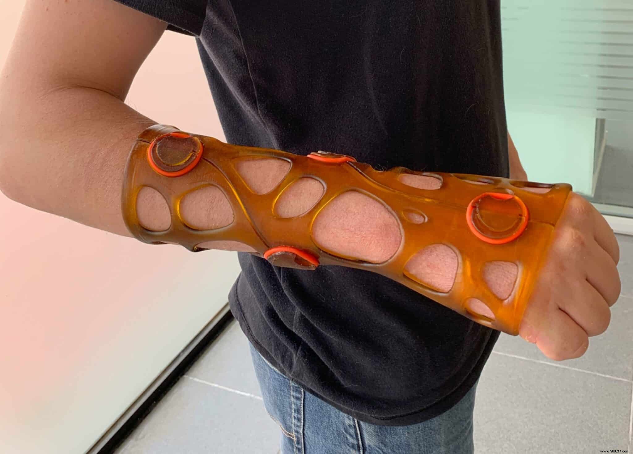 Xkelet: Spanish Startup s Revolutionary 3D-Printed Casts Made via Smartphone App