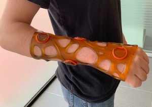 Xkelet: Spanish Startup s Revolutionary 3D-Printed Casts Made via Smartphone App