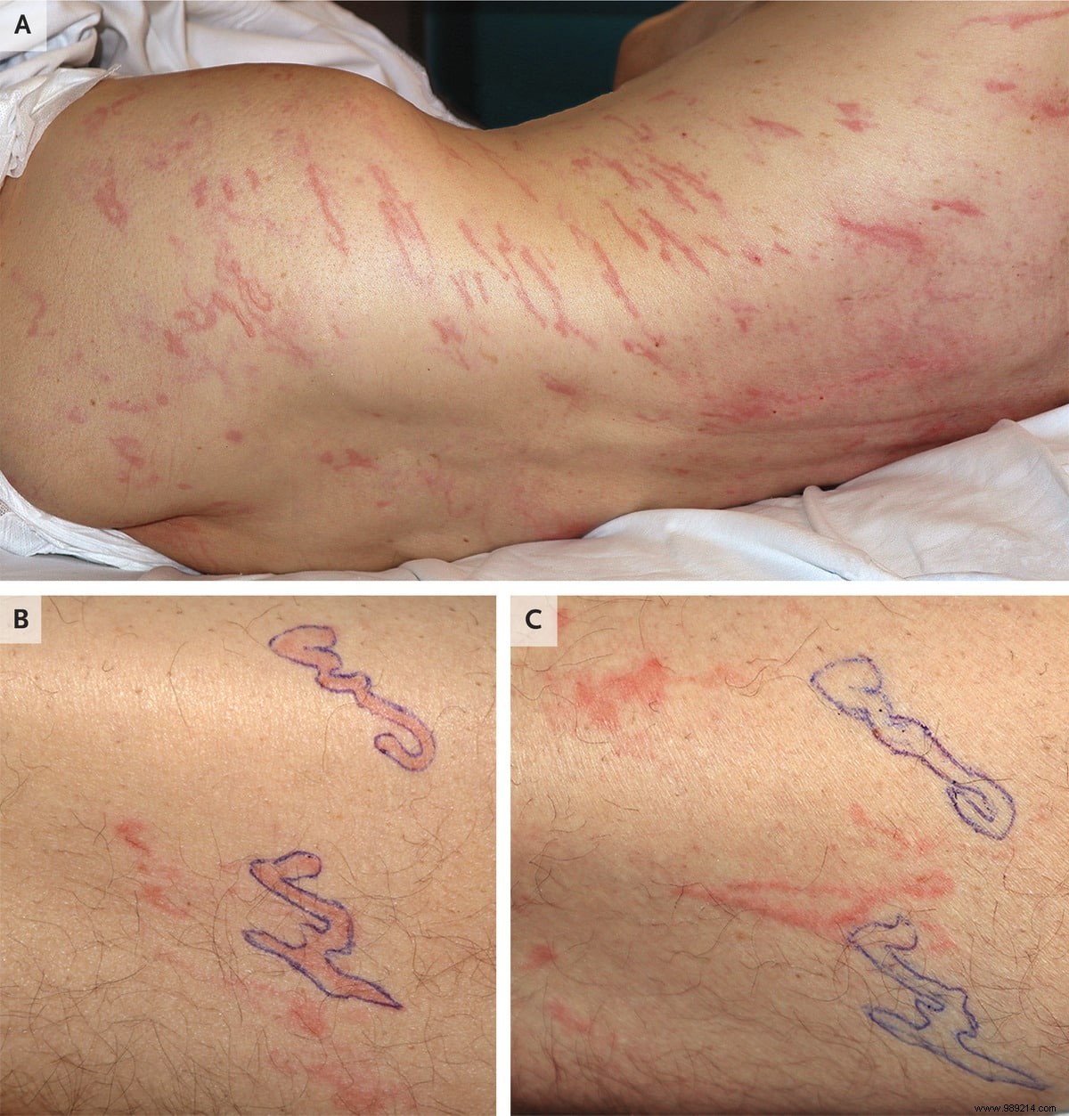 Rare Hyperinfection: Strongyloides Larvae Migrate Under Skin of Immunosuppressed Cancer Patient