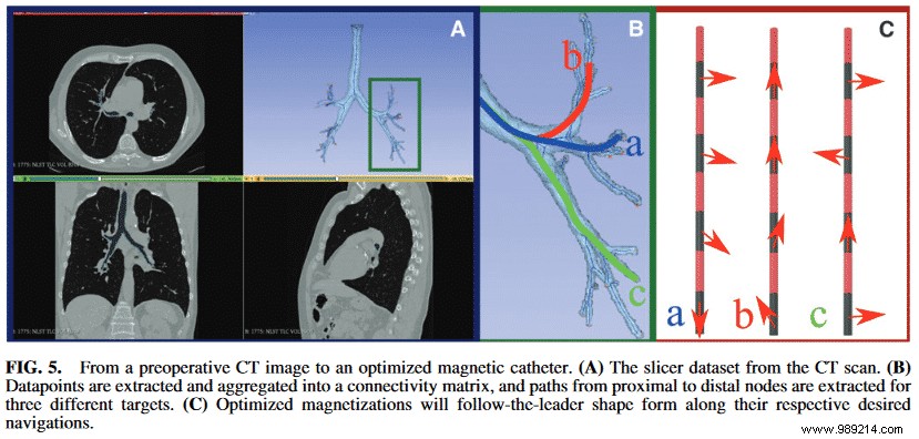 Breakthrough Soft Robot Navigates Deep into Lungs for Early Cancer Detection