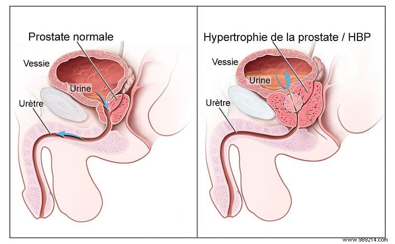 Dutch Breakthrough: Targeting Circadian Proteins to Overcome Prostate Cancer Resistance