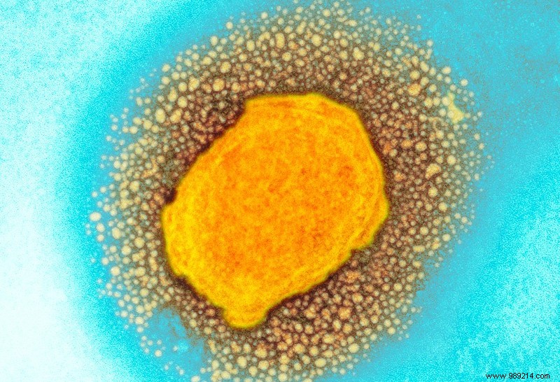 Monkeypox Virus Shows Accelerated Evolution: Genetic Study Reveals Rapid Mutations