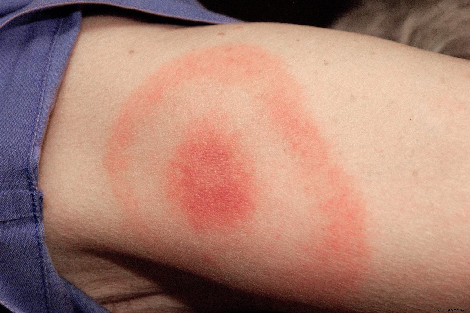 Lyme Disease Affects 14% of Global Population, New Meta-Study Reveals