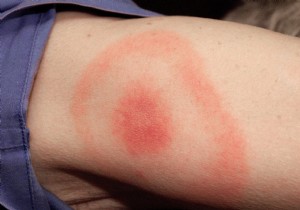 Lyme Disease Affects 14% of Global Population, New Meta-Study Reveals